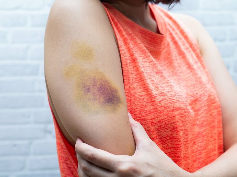 Help Heal Bruise